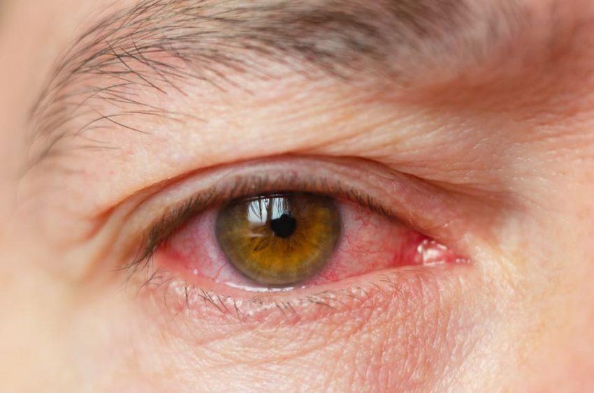 Ögoninflammation